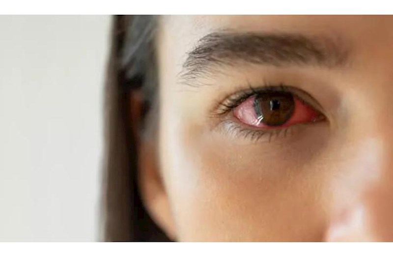 "Qırmızı göz" epidemiyasına görə məktəblər bağlandı