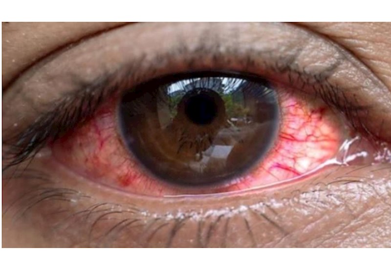 Uqandada "qırmızı göz" xəstəliyi yayıldı